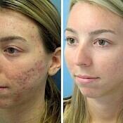 before and after images of best acne treatments - patient 8