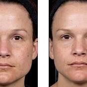 Before and after images of a female patient who successfully underwent laser resurfacing of her face - patient 3.
