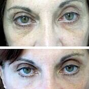Before and after images of a female patient who successfully underwent fractional CO2 laser treatment around her eyes.