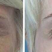 Before and after images of a patient who successfully underwent fractional CO2 laser treatment around her eyes.