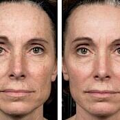 Before and after images of a female patient who successfully underwent Fraxel laser resurfacing of her face.