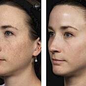 Before and after images of a female patient who successfully underwent Fraxel laser resurfacing of her face for blemishes.