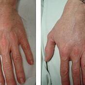 Before and after images of a patient who successfully underwent intense pulsed light treatment on hand.