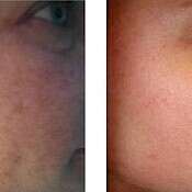 Before and after images of a patient who successfully underwent intense pulsed light treatment on right cheek.