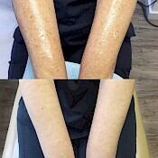 Before and after images of a patient who successfully underwent intense pulsed light treatment on forearm.
