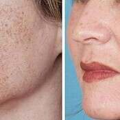 Before and after images of a female patient who successfully underwent intense pulsed light treatment on her face.