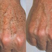 Before and after images of a patient who successfully underwent intense pulsed light treatment on hand.