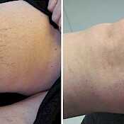 Before and after images of sclerotherapy leg vein treatment on thigh.
