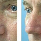Before and after images of laser vein removal of the nose.
