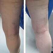 Before and after images of sclerotherapy leg vein treatment on the back side of the leg.