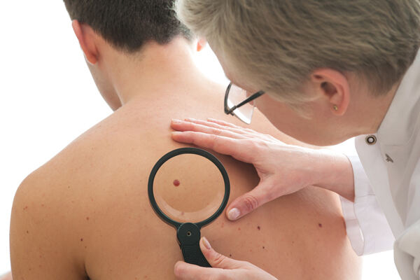 Provider examining the patient for skin tags and mole