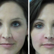 Before and after images of a female patient who successfully used Juvéderm nasolabial folds treatment on her face.