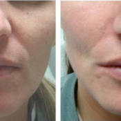 Before and after images of a female patient who successfully used deep wrinkle Fillers treatment on cheek.