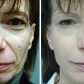 Before and after images of a female patient who successfully used deep wrinkle Fillers treatment on her face.