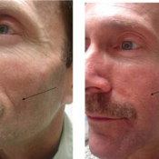 Before and after images of a male patient who successfully underwent Radiesse facial restoration treatment on his left cheek.