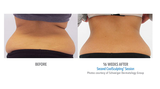 The CoolSculpting Center of NYC: Best Rated CoolSculpting® in NYC