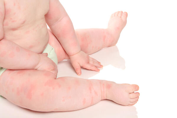 Saving your little ones from Eczema