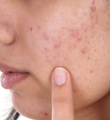 Acne scars on the skin of a female