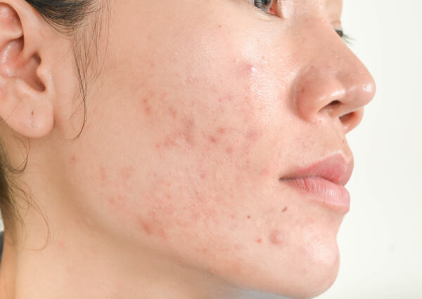 Acne and acne scars on woman's face