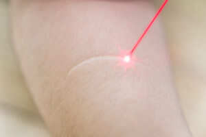 Laser Treatment for scars on the skin