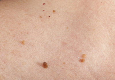 Skin tags on the body