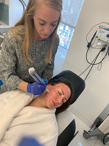 Woman enhancing her skin with microneedling