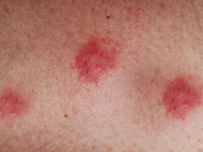 Skin flareup with Eczema