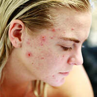 6 signs your adult acne may indicate a greater health issue