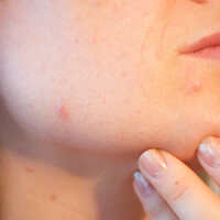 how-to-get-rid-of-a-cystic-pimple-according-to-dermatologist