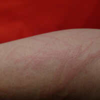 Dermatographism - 16-photos-that-show-what-dermatographism-looks-like