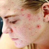 your diet may be why you still have acne