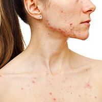 5 types of acne scars - What to do about them