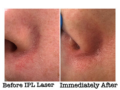 Before and After images showing effects of IPL laser treatment