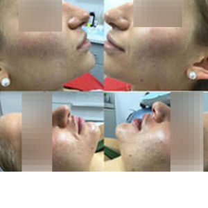 Microneedling before & after
