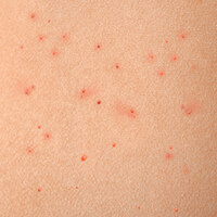 what-is-keratosis-pilaris-and-how-do-you-get-rid-of-it