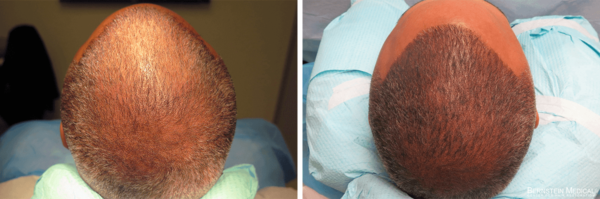 Before (left) and after (right) images of Scalp Micro-Pigmentation treatment.