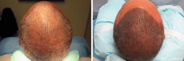 Scalp Micro-Pigmentation  Schweiger Dermatology Group