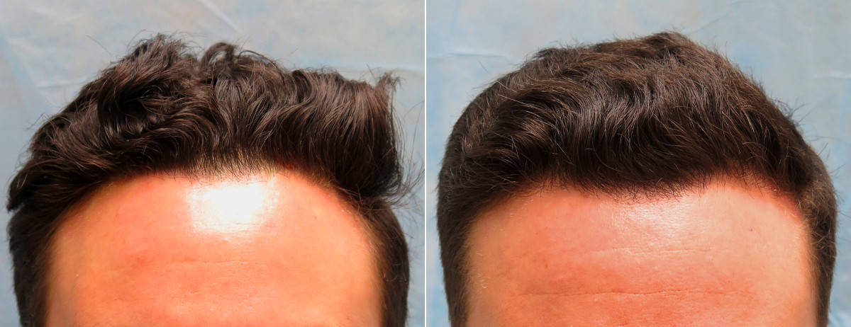 Before (left) and after (right) images of Platelet Rich Plasma Therapy