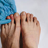 covid-toes-may-be-a-new-symptom-of-coronavirus-infection