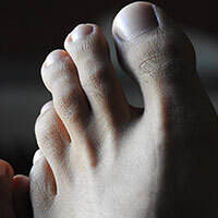 5-reasons-you-have-a-black-toenail-according-to-a-dermatologist