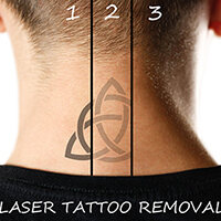 laser-tattoo-removal-from-prep-to-aftercare-heres-what-to-expect