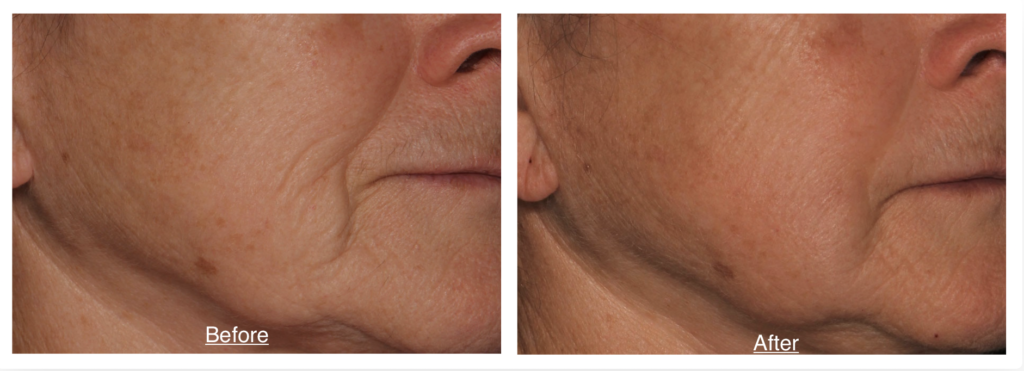 Before and after images of a female patient who successfully underwent Sofwave Treatment