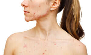 Woman with cystic acne on her face and body