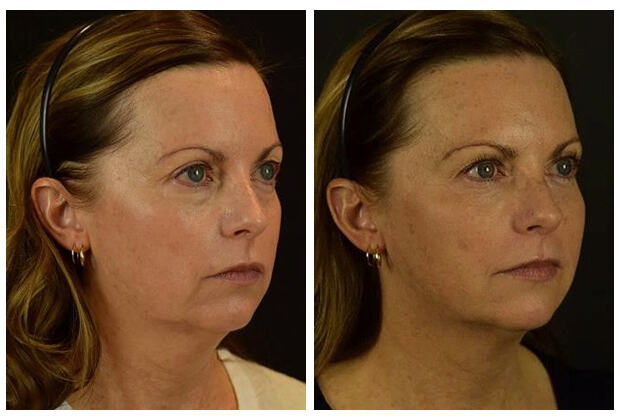 Before and After photos of a female patient who was treated with Silhouette InstaLift Thread Lift treatment