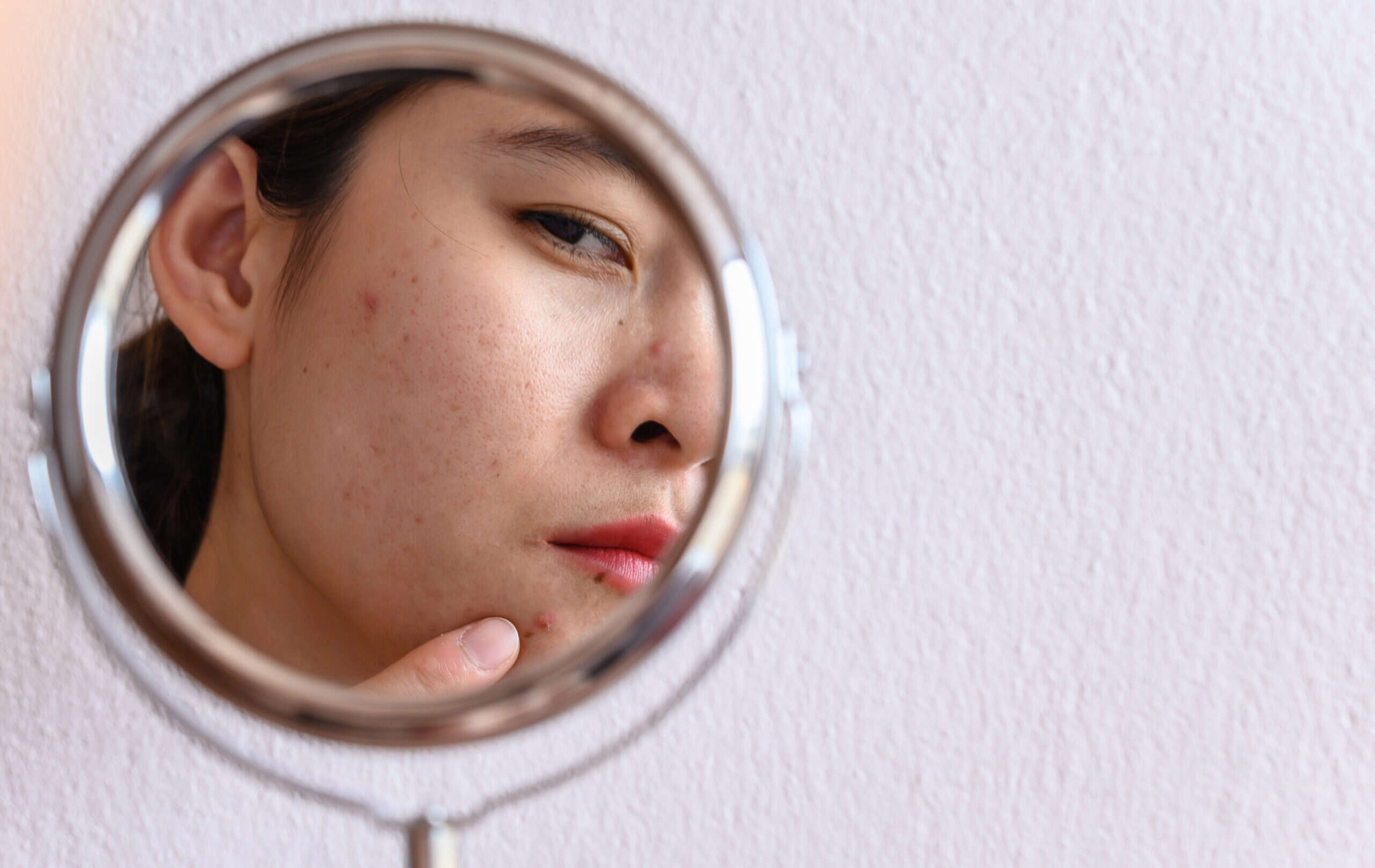 Skin of a woman affected with acne