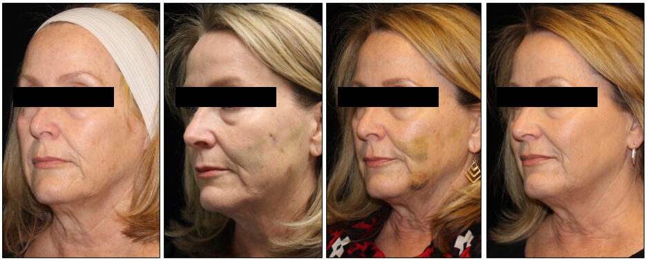 Before After images of a woman patient who underwent Thread Lift procedure