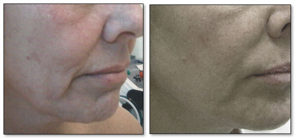 Before After images of a patient who underwent Thread Lift procedure