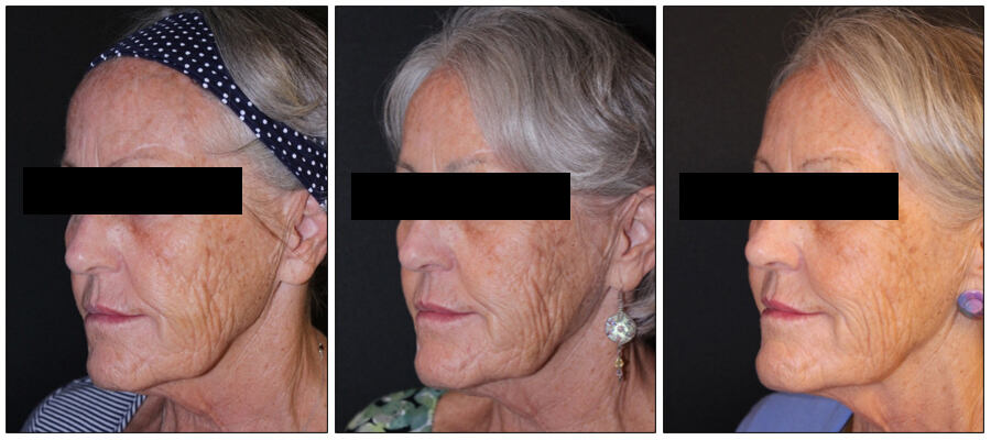 Before After images of a patient who underwent Thread Lift procedure