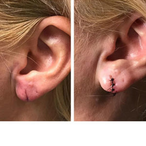 Surgical Earlobe Repair before & after