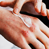 7 ways to treat eczema on your hands at home — and when to connect with a dermatologist